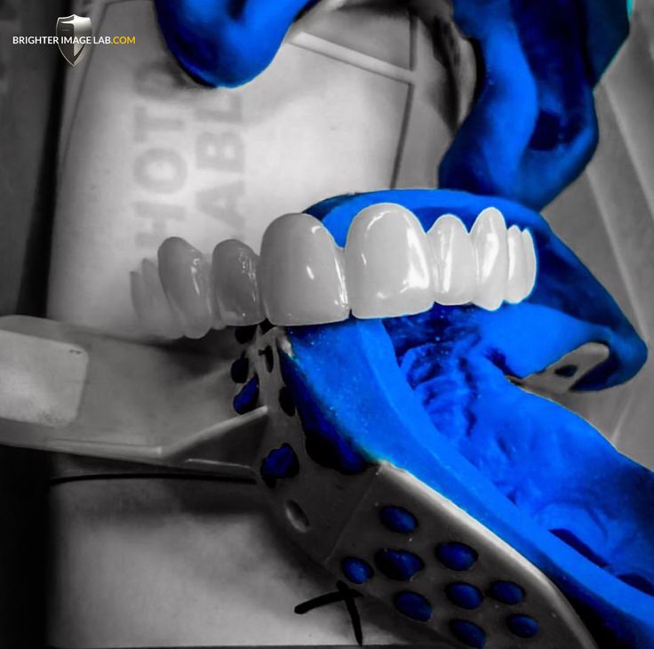 Veneer preparation